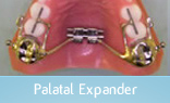 Palatal Expander